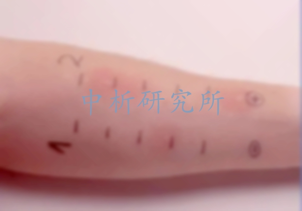 皮膚變態反應試驗
