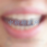 牙貼檢測